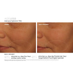 AGELESS Total Pure Hyaluronic6 Filler – Ergebnisse der klinischen Studie