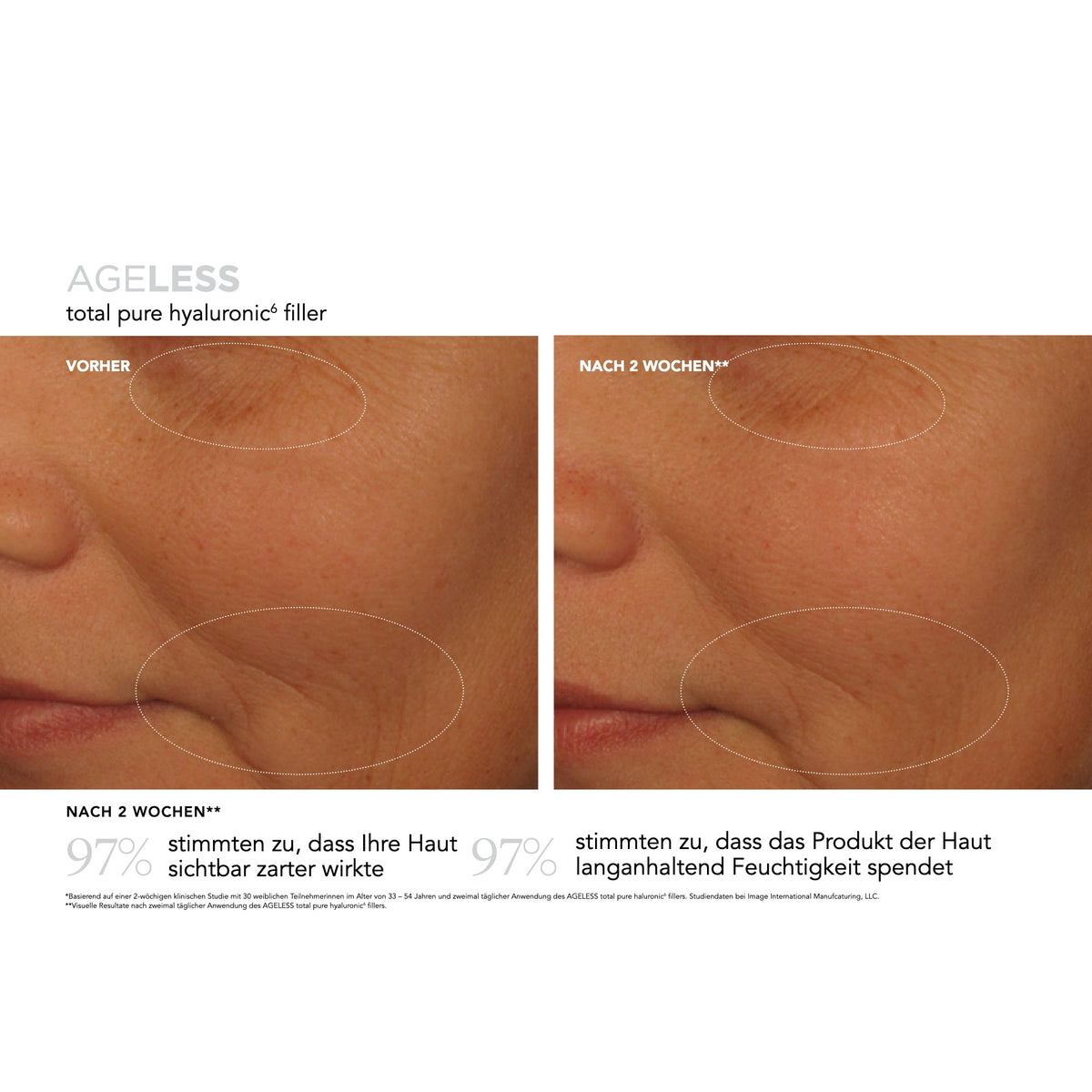 AGELESS Total Pure Hyaluronic6 Filler – Ergebnisse der klinischen Studie
