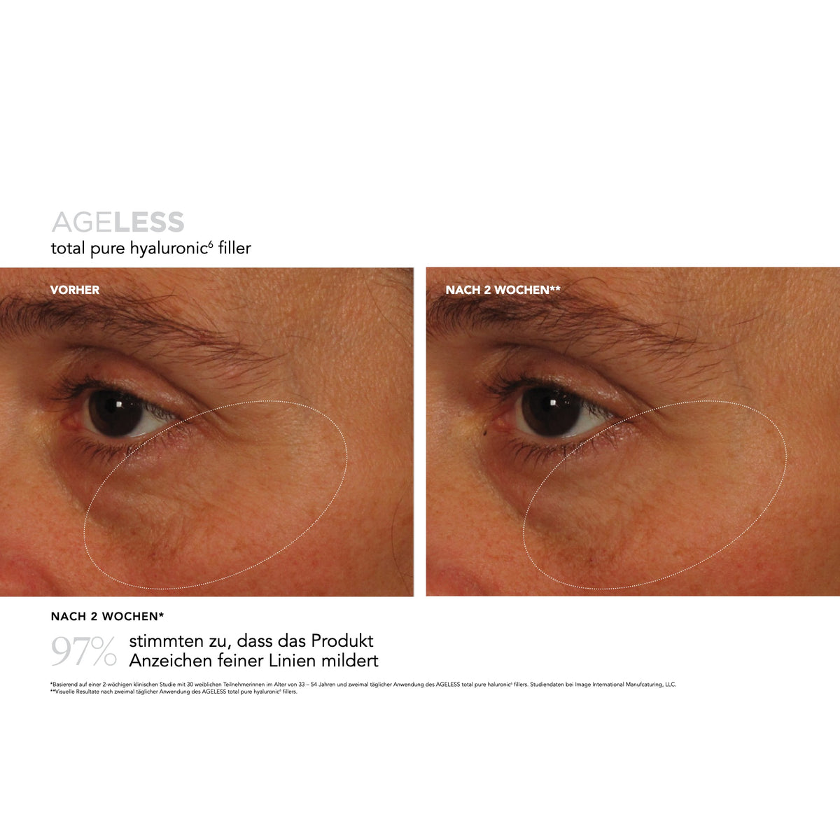 AGELESS Total Pure Hyaluronic6 Filler – Ergebnisse der klinischen Studie