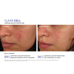 CLEAR CELL Clarifying Salicylic Blemish Gel – Ergebnisse der klinischen Studie