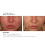CLEAR CELL Clarifying Salicylic Blemish Gel – Ergebnisse der klinischen Studie