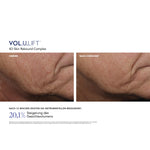 VOL.U.LIFT™ Face – Ergebnisse der klinischen Studie