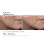 VOL.U.LIFT™ Face – Ergebnisse der klinischen Studie