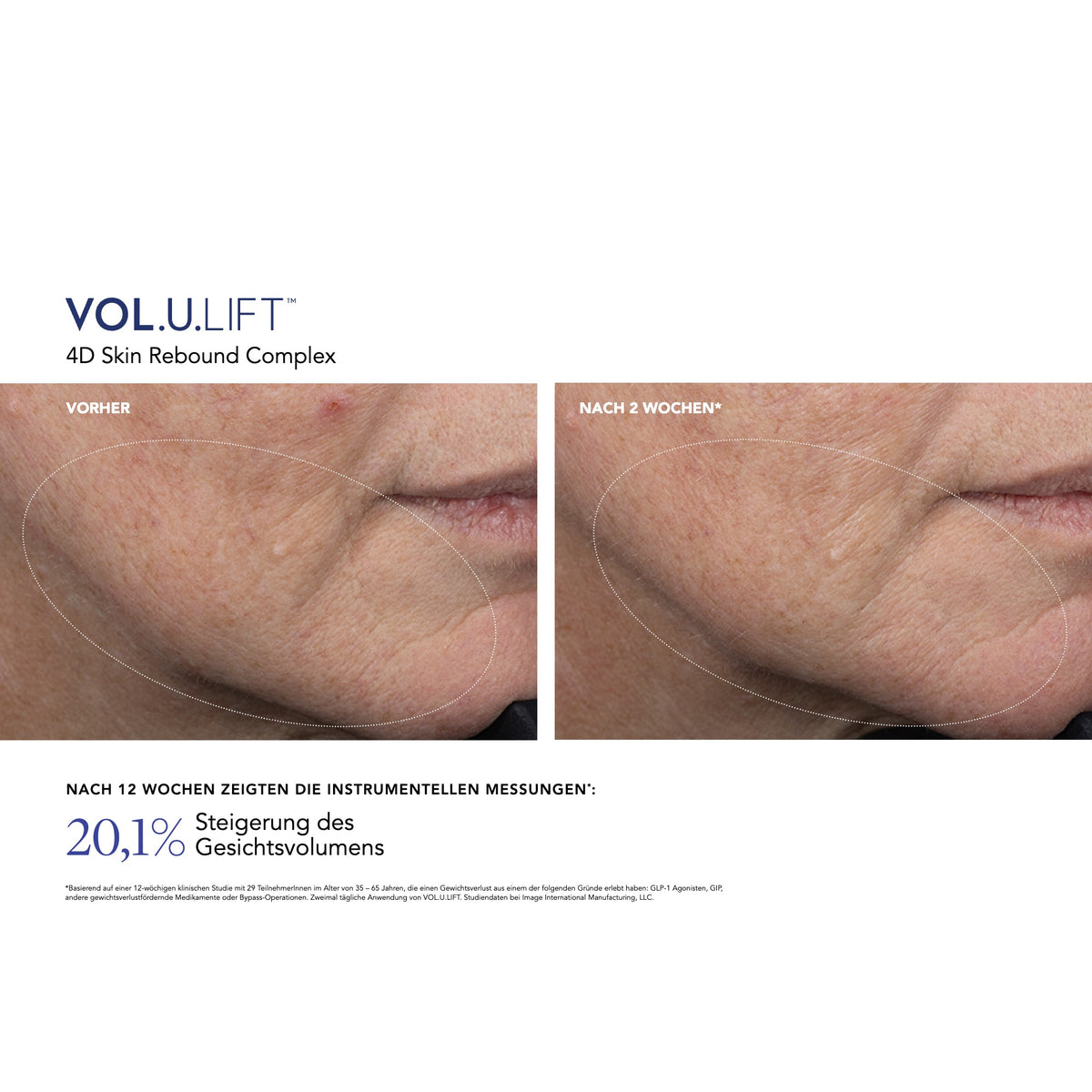 VOL.U.LIFT™ Face – Ergebnisse der klinischen Studie