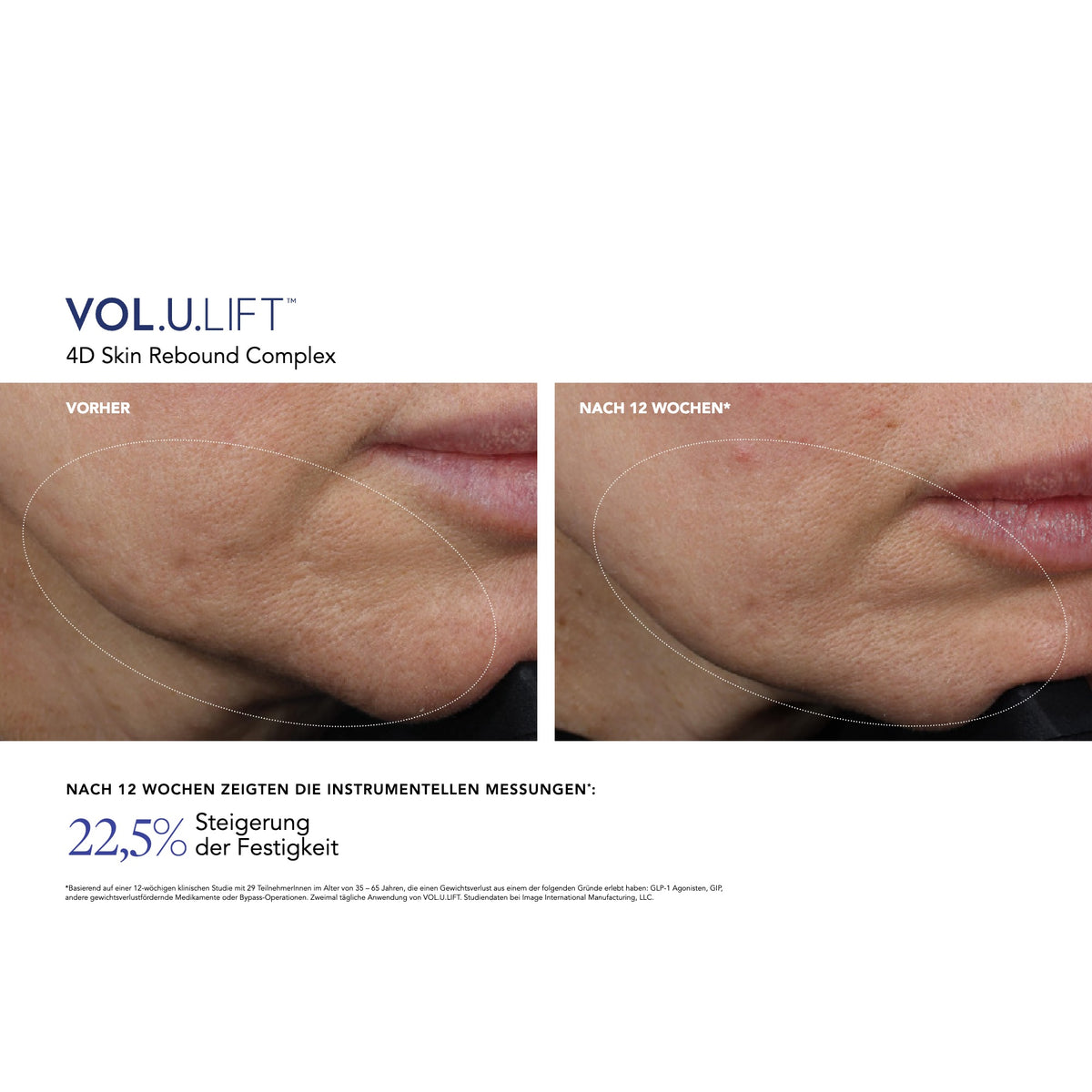 VOL.U.LIFT™ Face – Ergebnisse der klinischen Studie