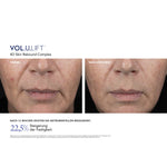 VOL.U.LIFT™ Face – Ergebnisse der klinischen Studie