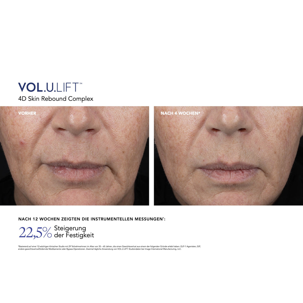 VOL.U.LIFT™ Face – Ergebnisse der klinischen Studie