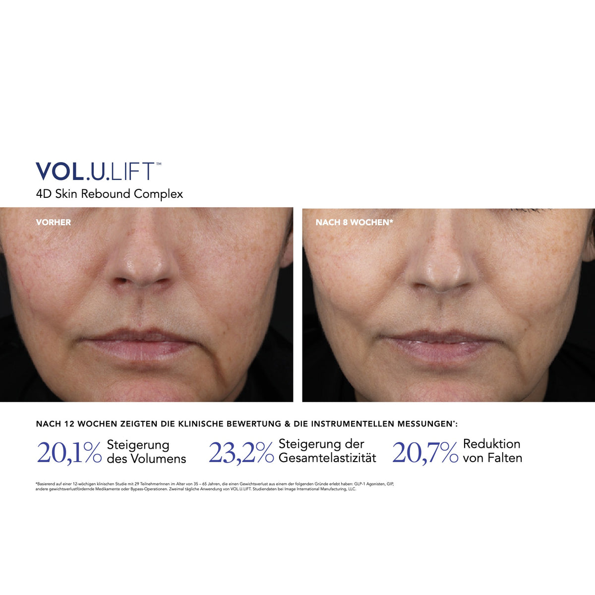VOL.U.LIFT™ Face – Ergebnisse der klinischen Studie