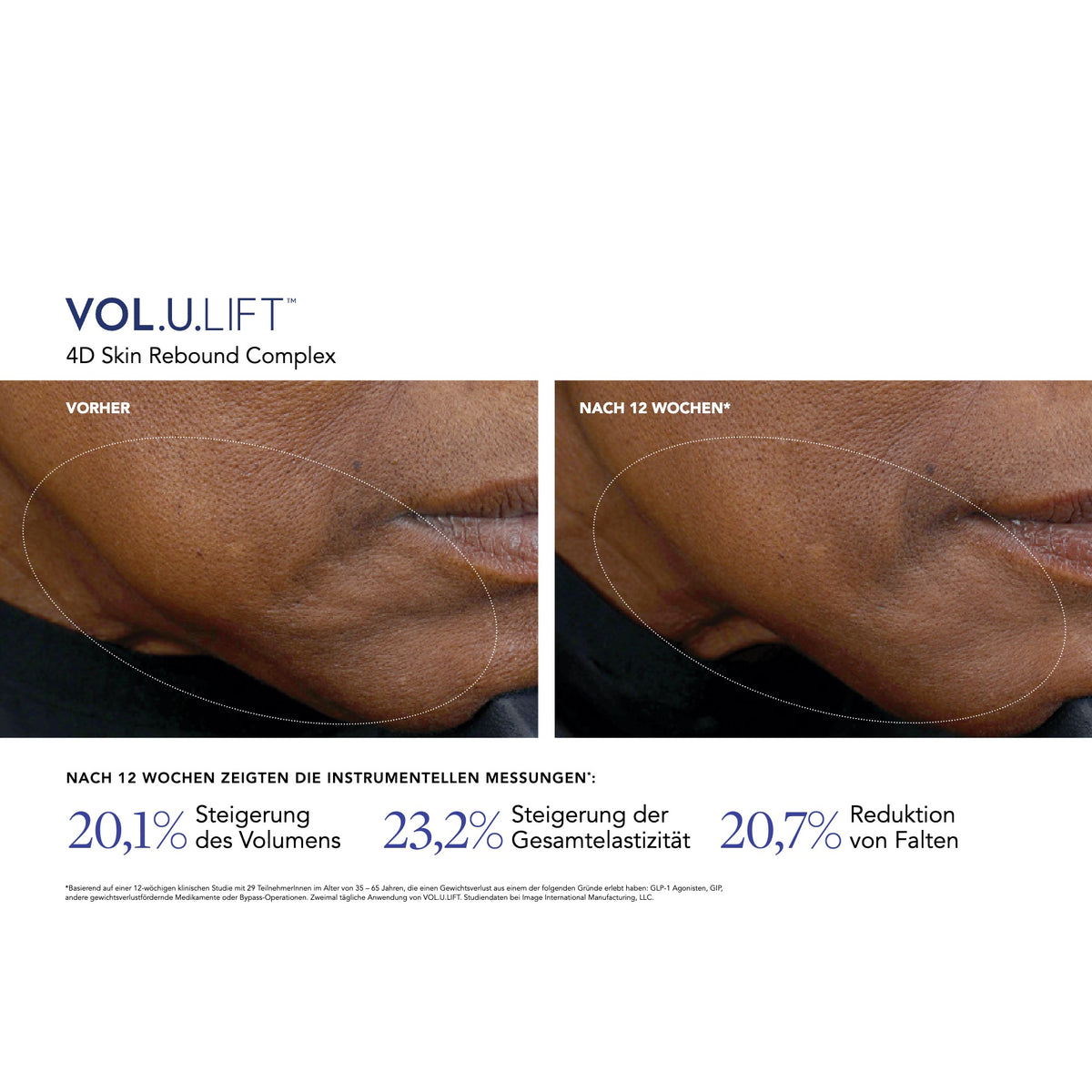 VOL.U.LIFT™ Face – Ergebnisse der klinischen Studie