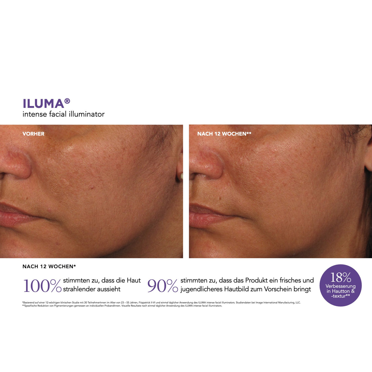 ILUMA™ Intense Facial Illuminator – Ergebnisse der klinischen Studie