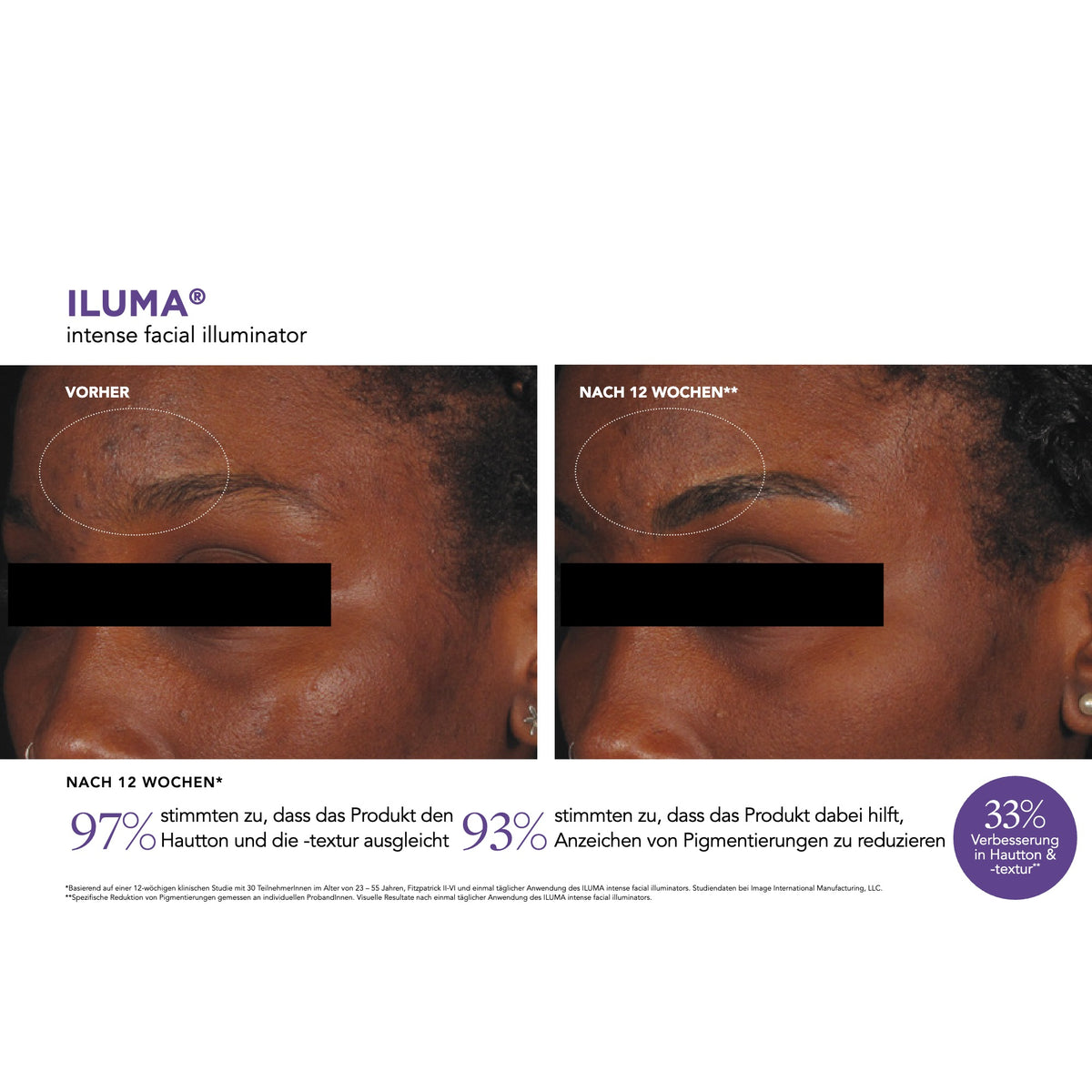 ILUMA™ Intense Facial Illuminator – Ergebnisse der klinischen Studie