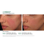 ORMEDIC® Balancing Bio-Peptide Crème – Ergebnisse der klinischen Studie